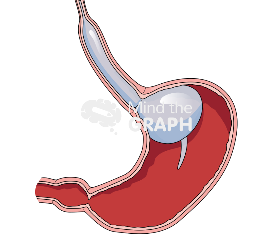 Sengstaken tube stomach cut Icons, Symbols, Pictures, and Images