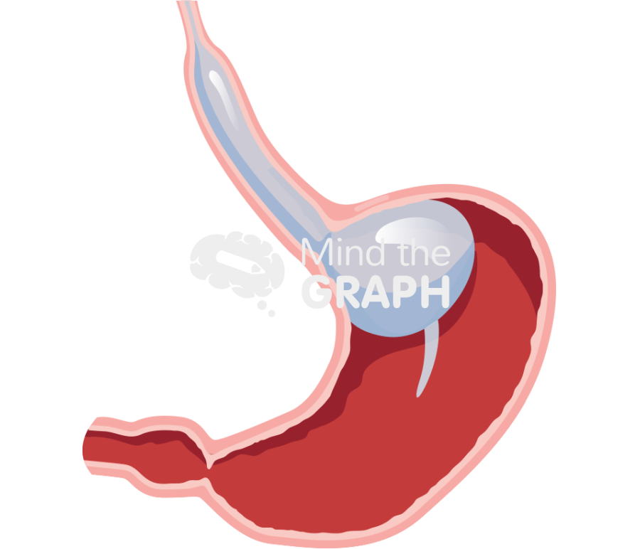 Sengstaken tube stomach cut Icons, Symbols, Pictures, and Images