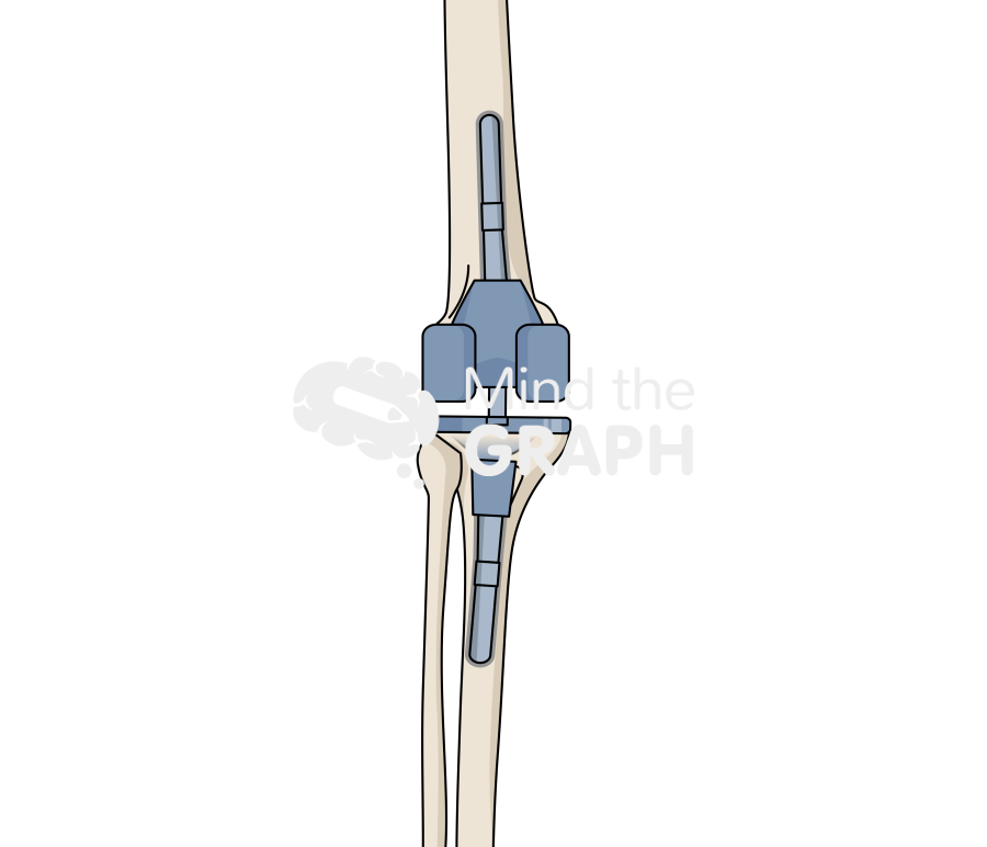 Short cemented stem cone anterior posterior bone full Icons, Symbols, Pictures, and Images