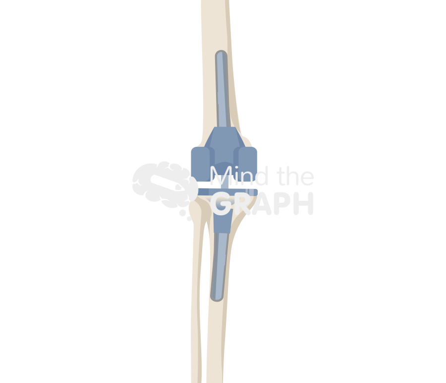 Short cemented stem cone anterior posterior bone full Icons, Symbols, Pictures, and Images