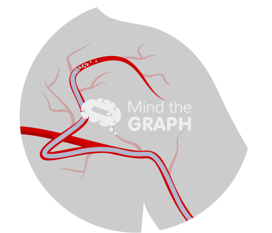 Shoulder embolization 2 Icons, Symbols, Pictures, and Images