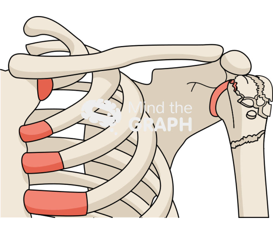 Shoulder fracture Icons, Symbols, Pictures, and Images