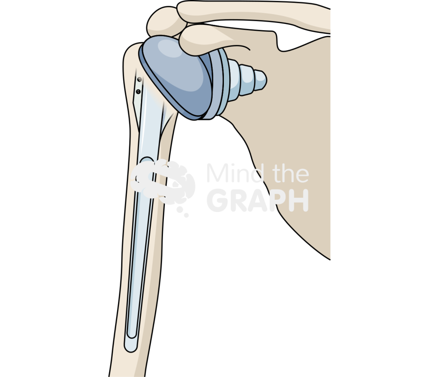 Shoulder replacement bone full Icons, Symbols, Pictures, and Images