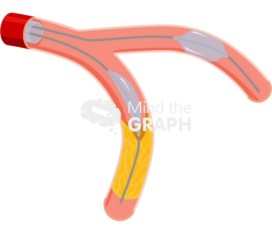 Side branch anchoring technique longitudinal cut Icons, Symbols, Pictures, and Images
