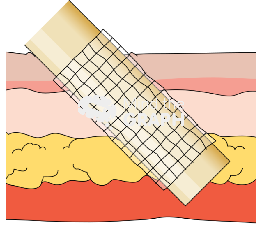 Silicone tube wrapped skin Icons, Symbols, Pictures, and Images