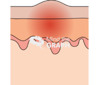 Skin eruption cut lateral - Edit and Customize Icons of Skin eruption cut lateral Skin eruption cut lateral Icons, Symbols, Pictures, and Images
