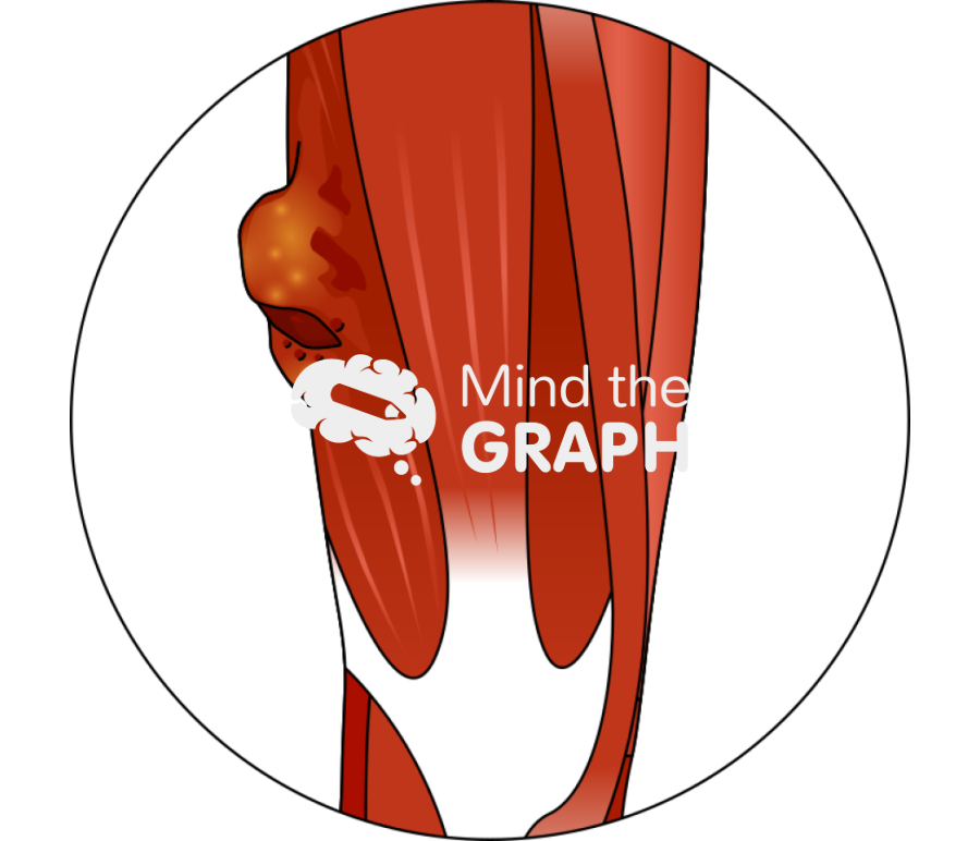 Soft tissue sarcoma zoom Icons, Symbols, Pictures, and Images