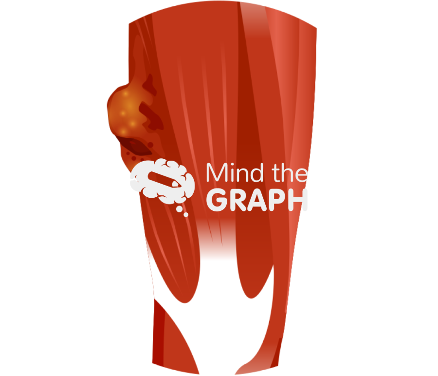 Soft tissue sarcoma zoom Icons, Symbols, Pictures, and Images