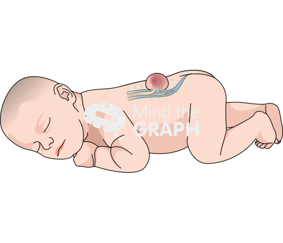 Spina bifida newborn Icons, Symbols, Pictures, and Images