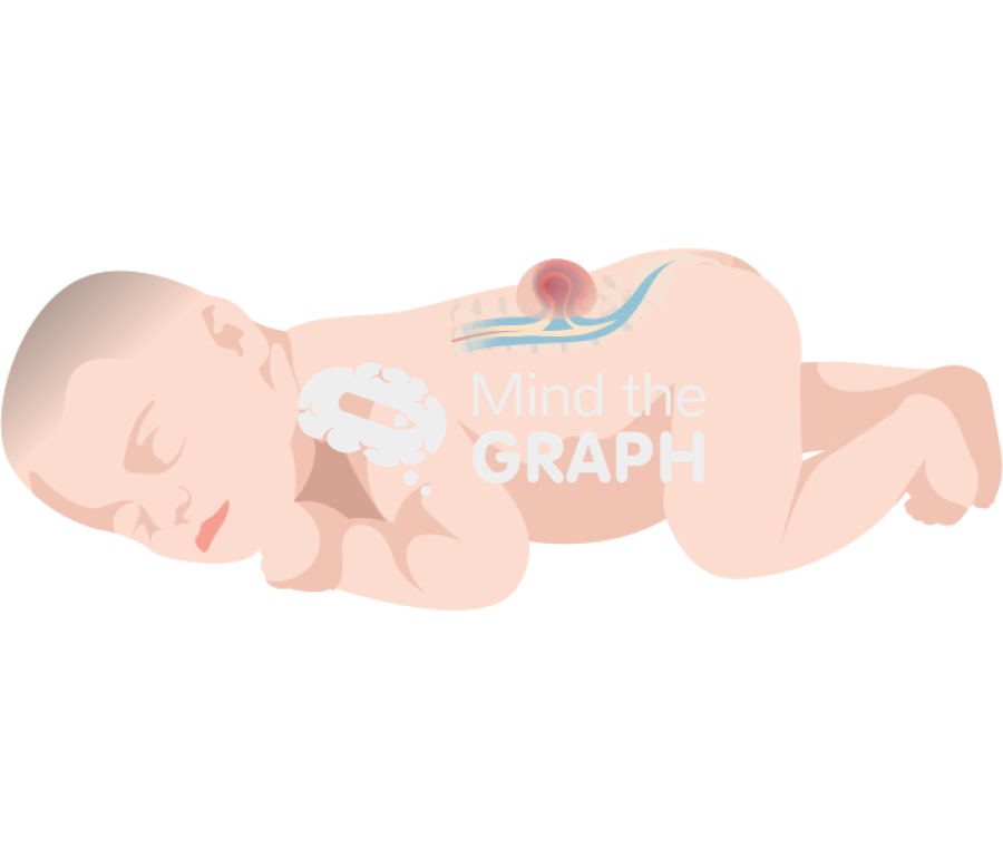 Spina bifida newborn Icons, Symbols, Pictures, and Images