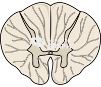 Spinal cord cut t8