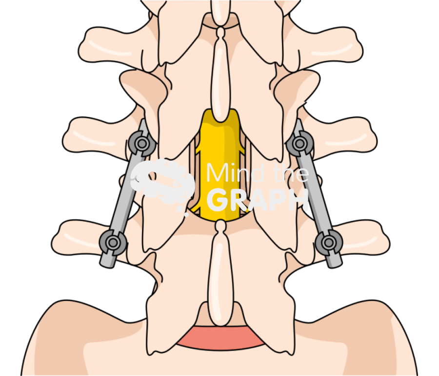 Spinal fusion decompression Icons, Symbols, Pictures, and Images