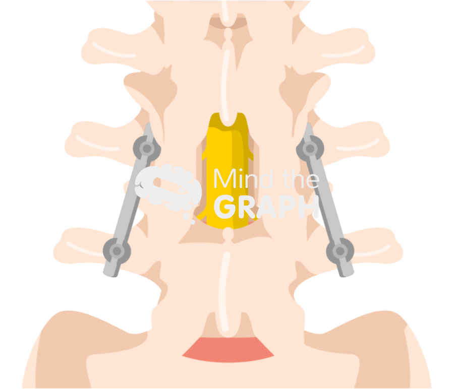 Spinal fusion decompression Icons, Symbols, Pictures, and Images