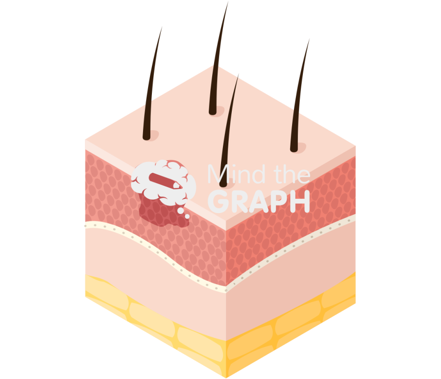Squamous cell carcinoma skin perspective Icons, Symbols, Pictures, and Images