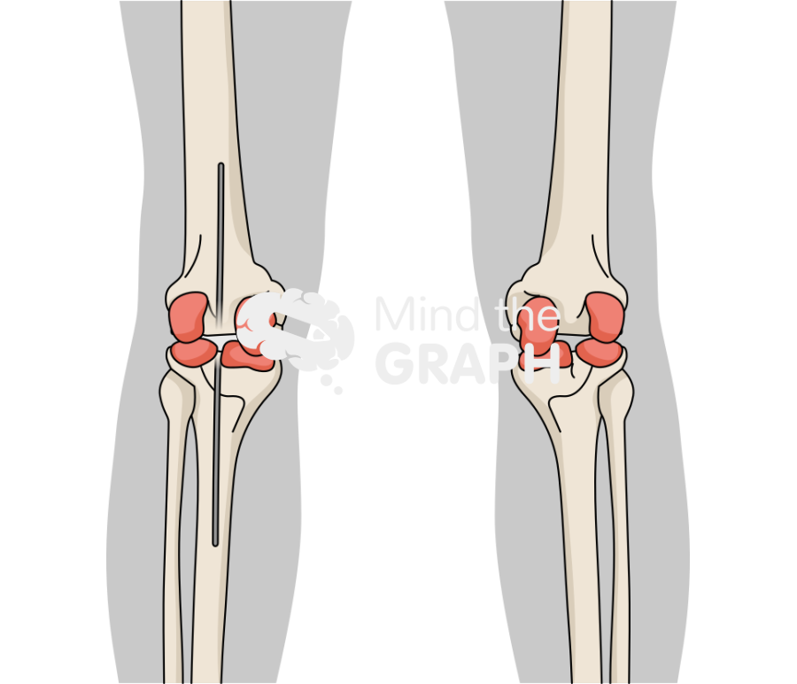 Static abx spacer anteroposterior body Icons, Symbols, Pictures, and Images