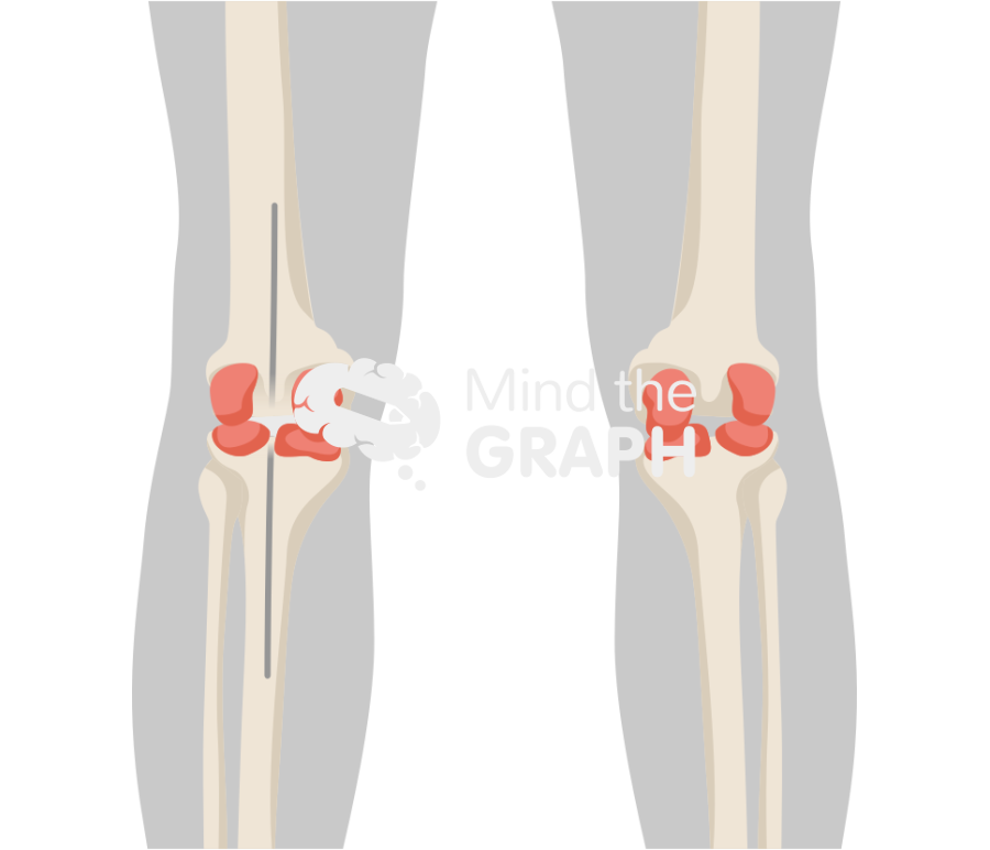Static abx spacer anteroposterior body Icons, Symbols, Pictures, and Images