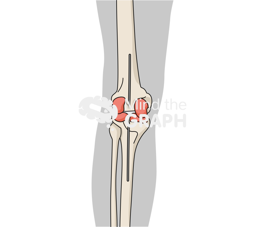 Static abx spacer anteroposterior bone full Icons, Symbols, Pictures, and Images
