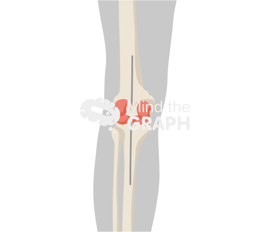 Static abx spacer anteroposterior bone full Icons, Symbols, Pictures, and Images