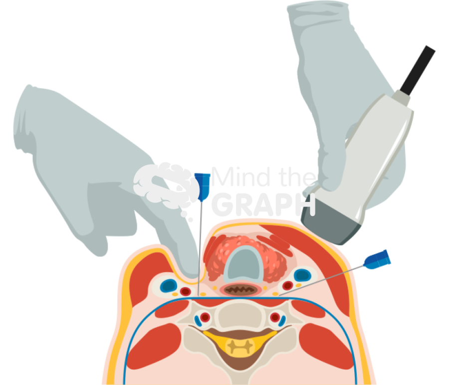 Stellate ganglion block Icons, Symbols, Pictures, and Images