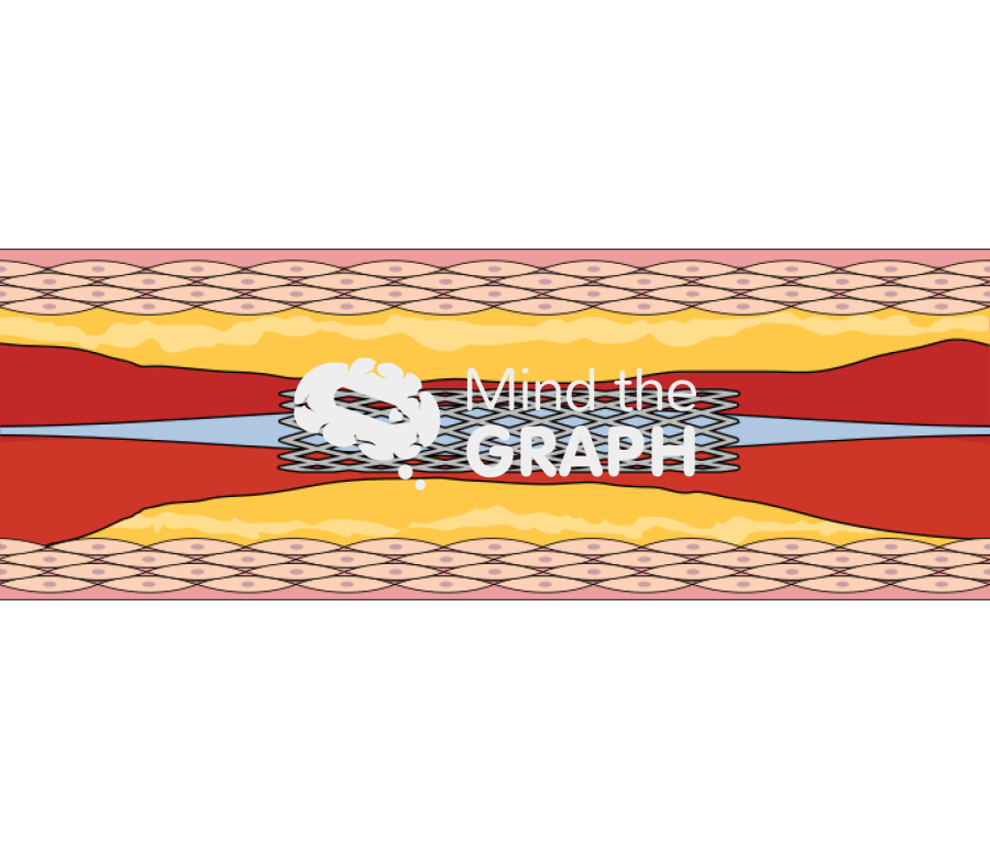 Stent 1 crimped complex Icons, Symbols, Pictures, and Images