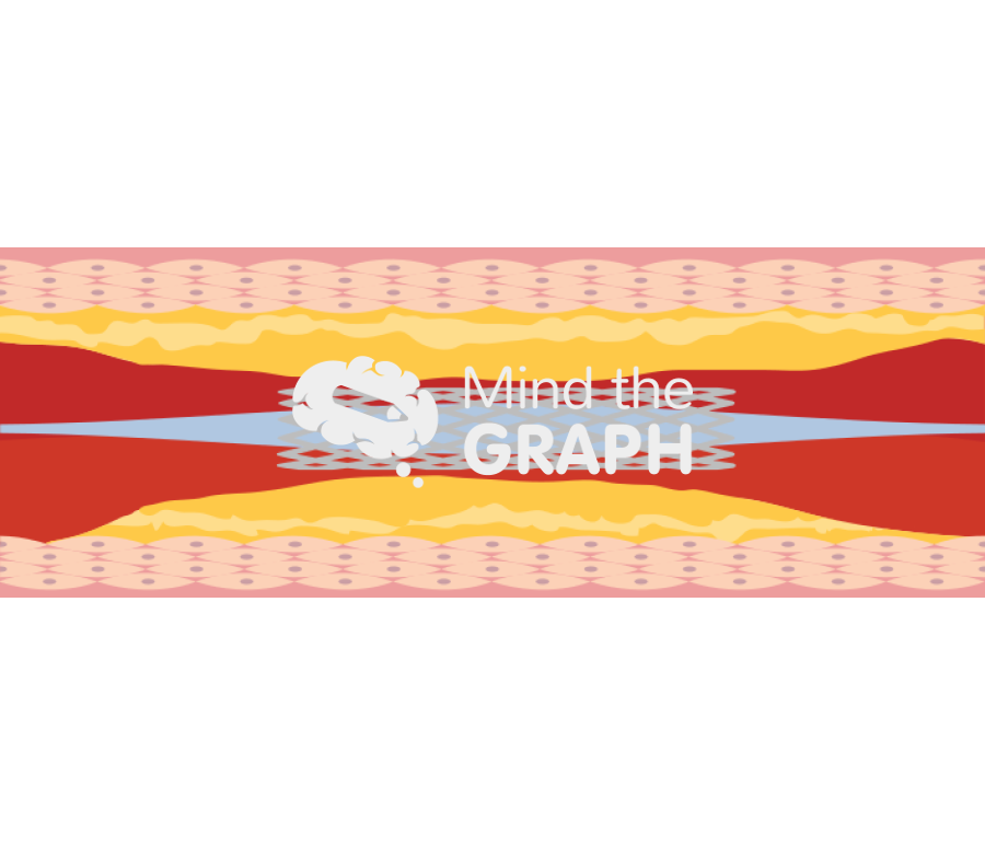 Stent 1 crimped complex Icons, Symbols, Pictures, and Images