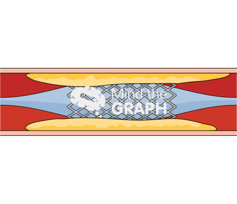 Stent 1 inflation baloon Icons, Symbols, Pictures, and Images