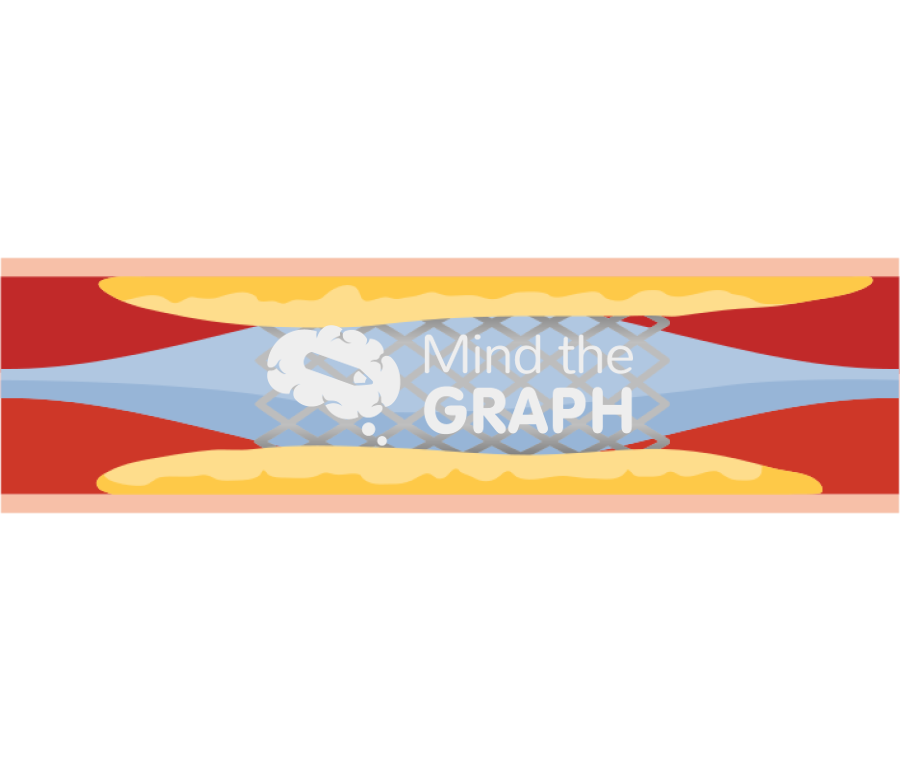 Stent 1 inflation baloon Icons, Symbols, Pictures, and Images