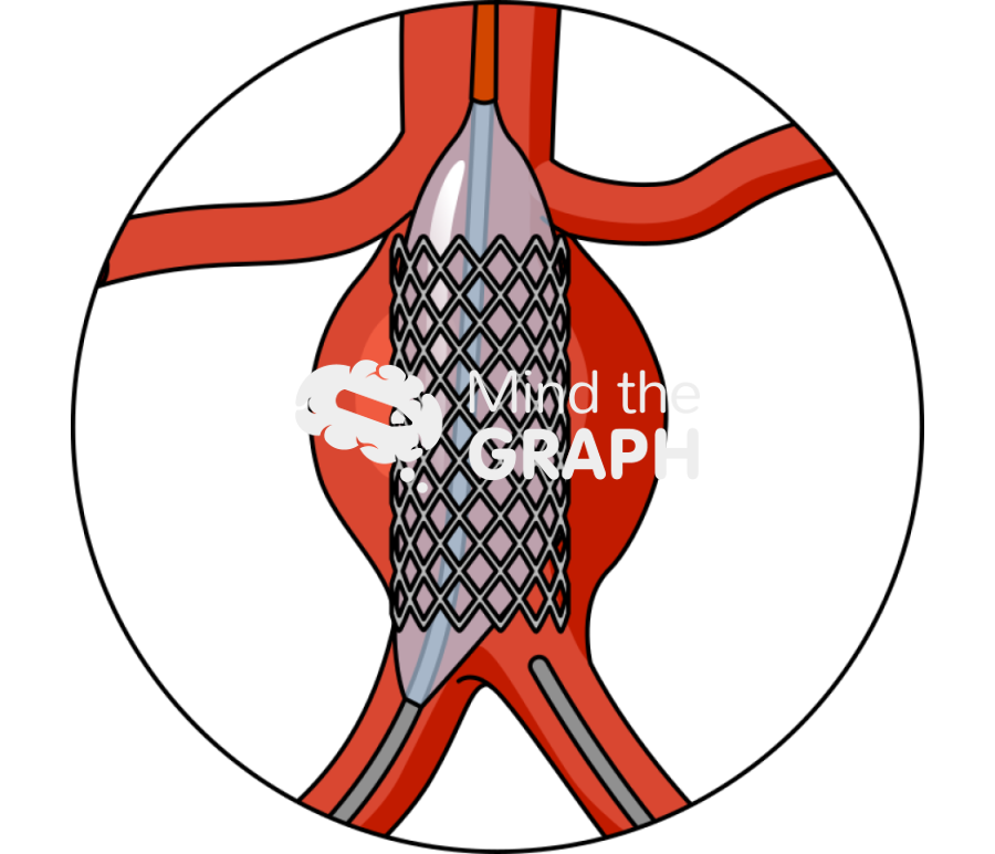 Stent graft released catheter zoom Icons, Symbols, Pictures, and Images