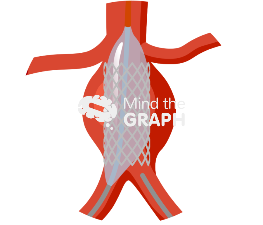 Stent graft released catheter zoom Icons, Symbols, Pictures, and Images