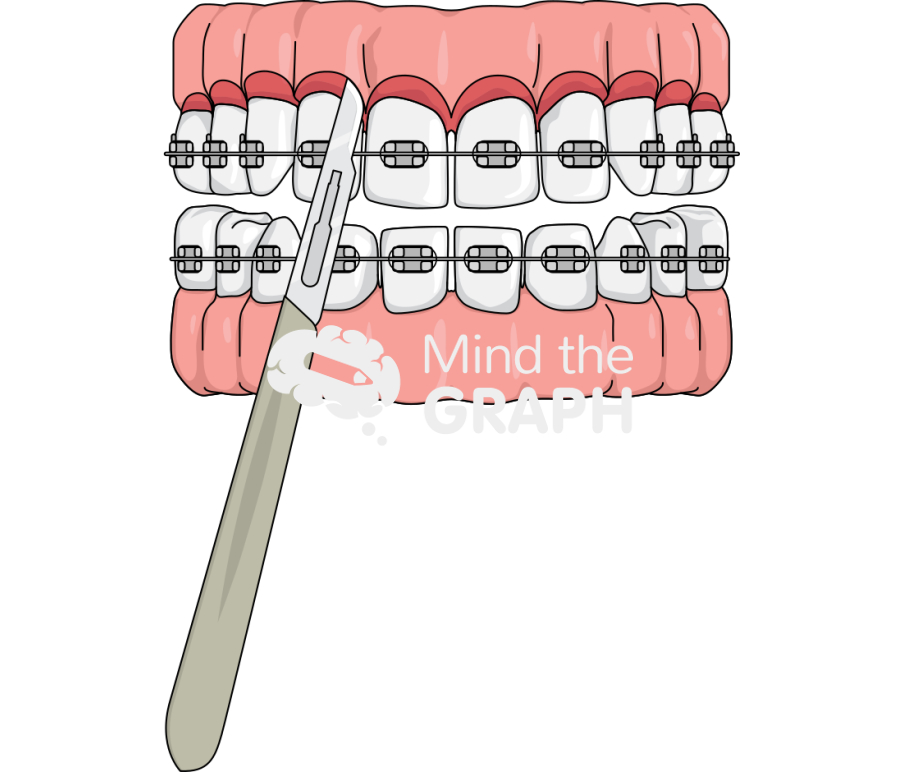 Supracrestal circumferential fiberotomy Icons, Symbols, Pictures, and Images