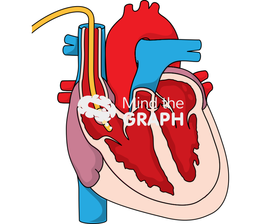 Swan ganz pulmonary artery catheter right atrium Icons, Symbols, Pictures, and Images