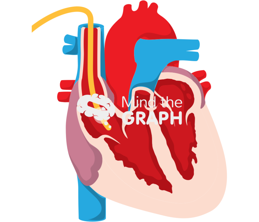 Swan ganz pulmonary artery catheter right atrium Icons, Symbols, Pictures, and Images