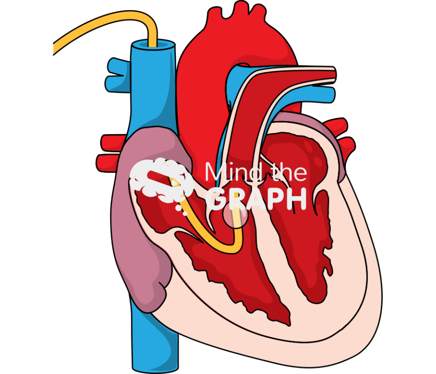 Swan ganz pulmonary artery catheter right ventricle Icons, Symbols, Pictures, and Images