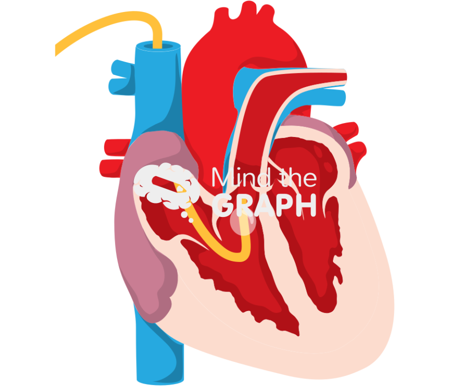 Swan ganz pulmonary artery catheter right ventricle Icons, Symbols, Pictures, and Images