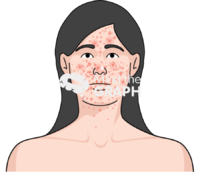 Systemic lupus erythematosus - Edit and Customize Icons of Systemic lupus erythematosus Systemic lupus erythematosus Icons, Symbols, Pictures, and Images