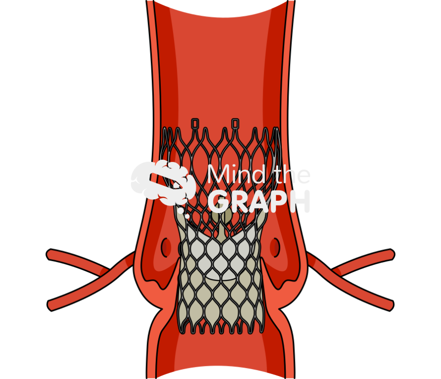 Tavr transcatheter aortic valve replacement 3 Icons, Symbols, Pictures, and Images