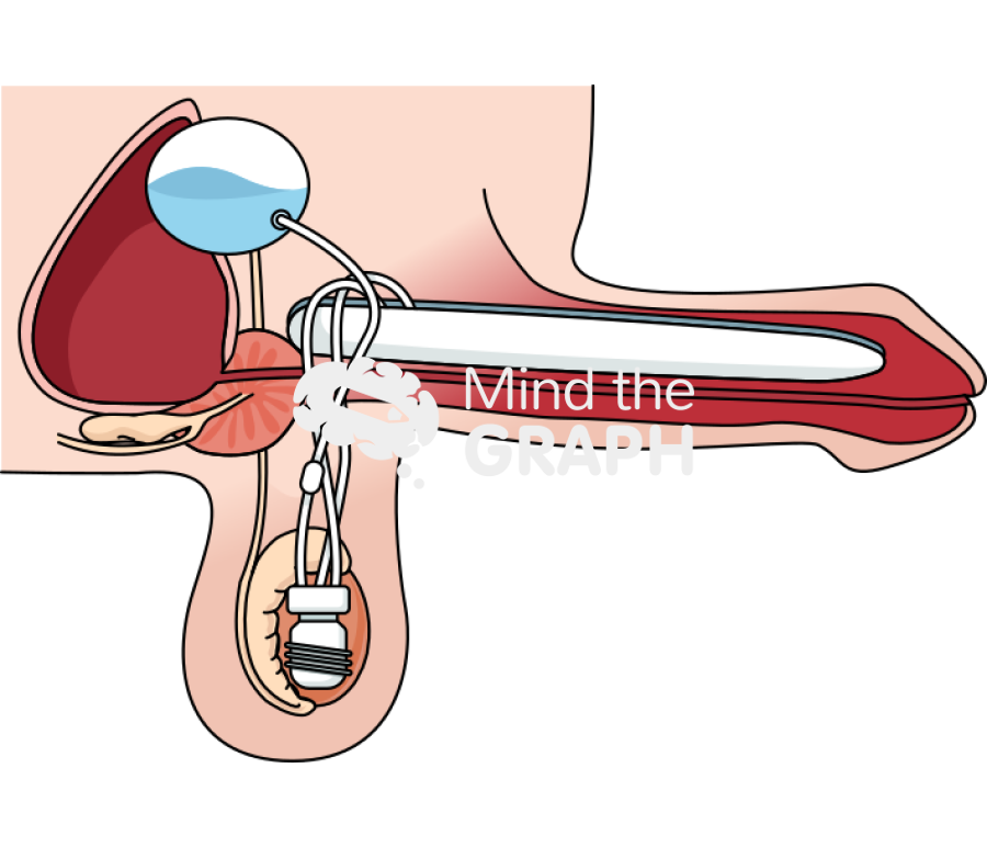 Three piece inflatable penile implant erect Icons, Symbols, Pictures, and Images
