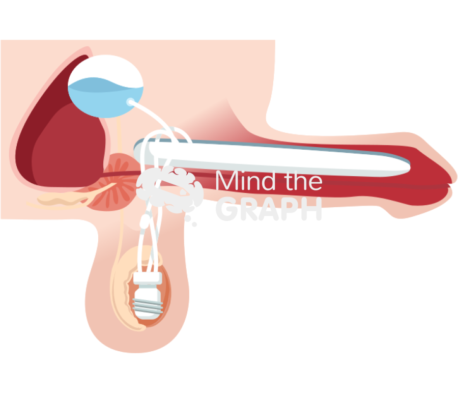 Three piece inflatable penile implant erect Icons, Symbols, Pictures, and Images