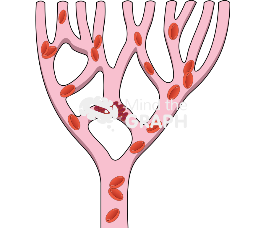 Thrombus position and consequences Icons, Symbols, Pictures, and Images
