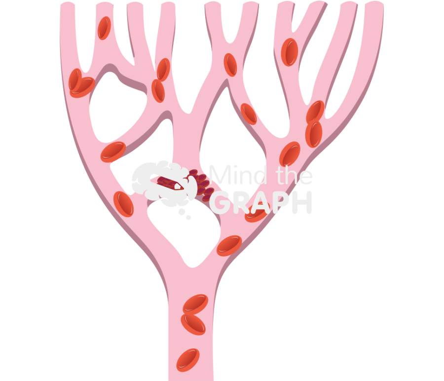 Thrombus position and consequences Icons, Symbols, Pictures, and Images