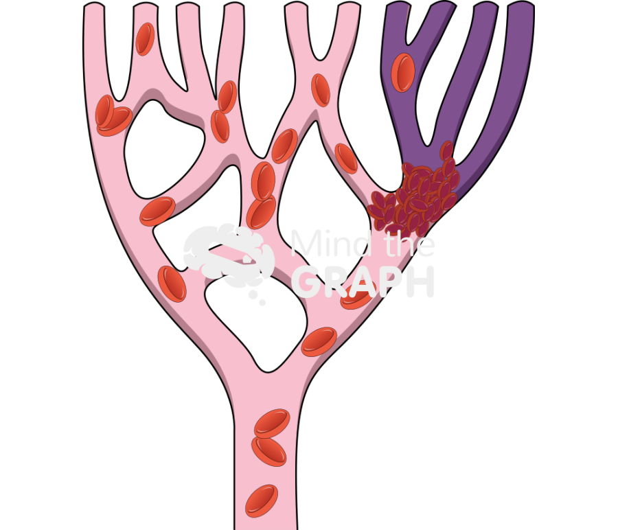 Thrombus position and consequences 2 Icons, Symbols, Pictures, and Images