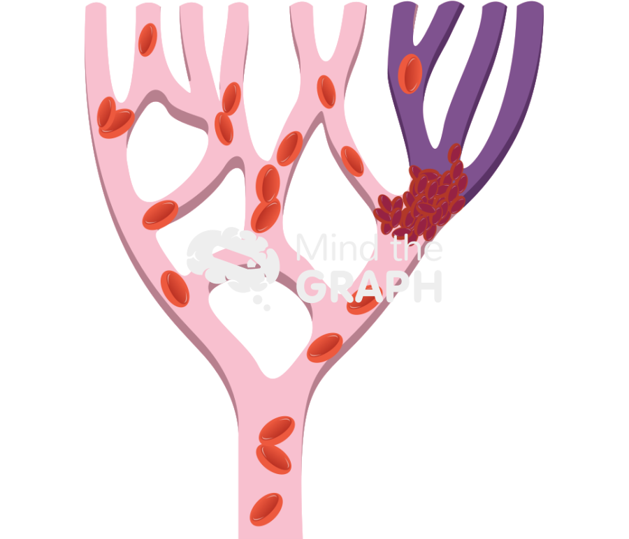 Thrombus position and consequences 2 Icons, Symbols, Pictures, and Images