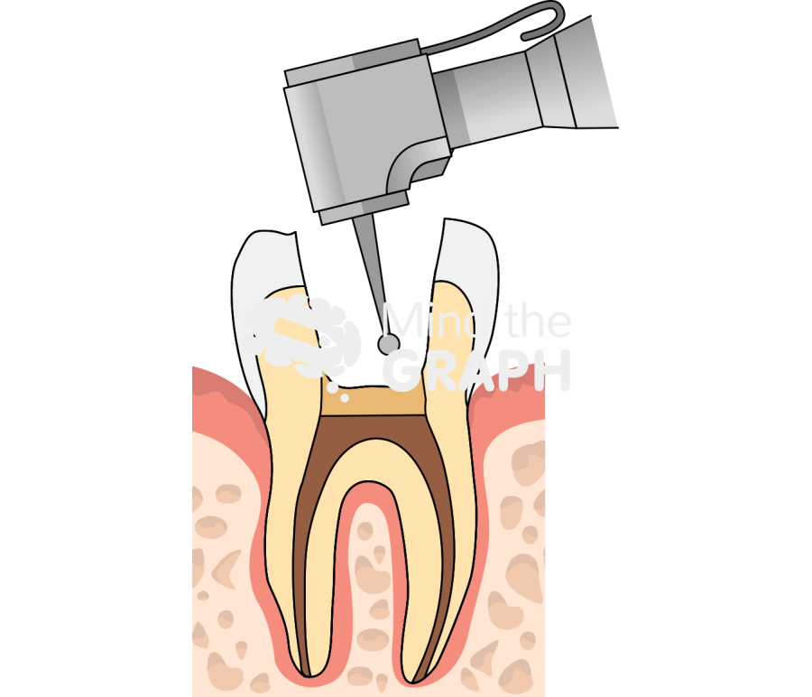 Tooth treatment root canal 1 Icons, Symbols, Pictures, and Images