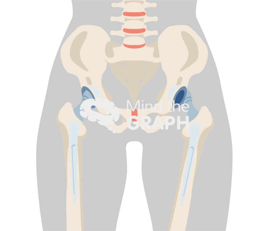 Total hip arthroplasty dislocation body Icons, Symbols, Pictures, and Images