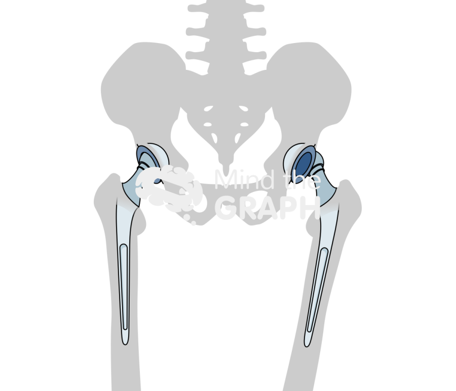Total hip arthroplasty dislocation bone Icons, Symbols, Pictures, and Images