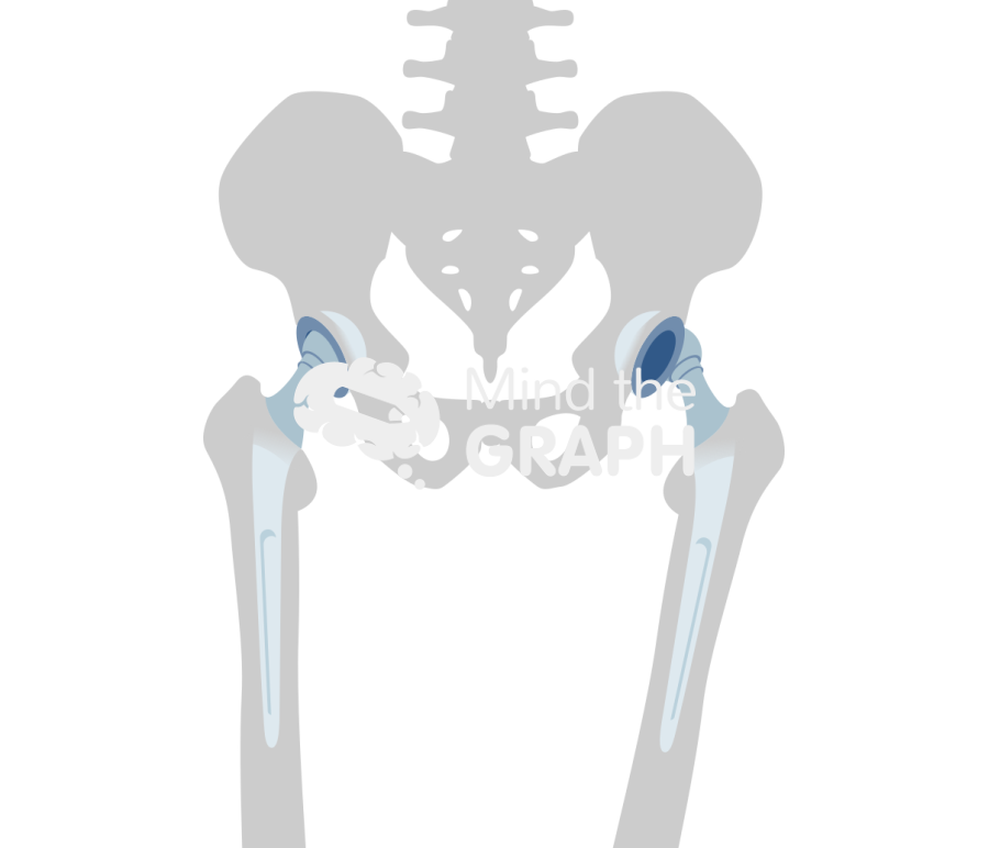 Total hip arthroplasty dislocation bone Icons, Symbols, Pictures, and Images