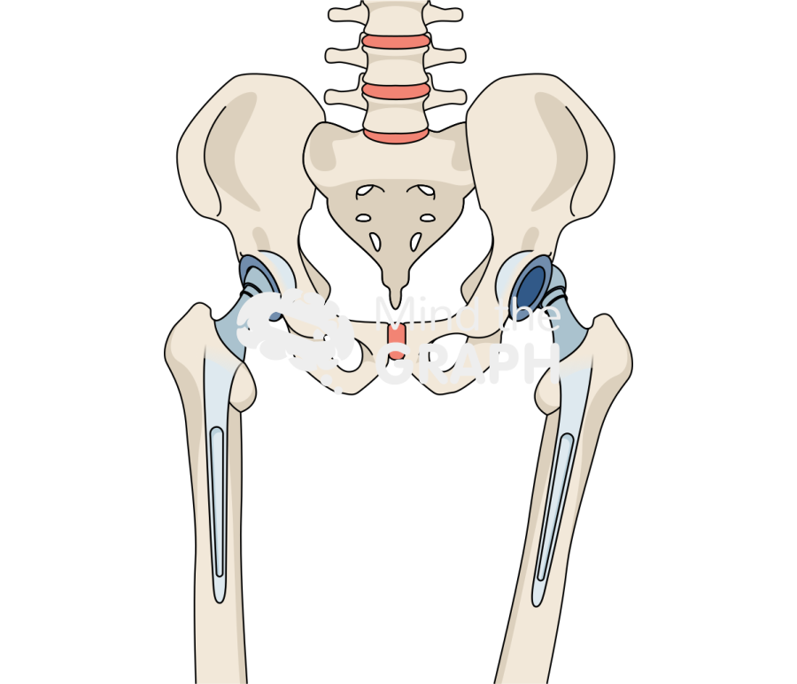 Total hip arthroplasty dislocation bone full Icons, Symbols, Pictures, and Images