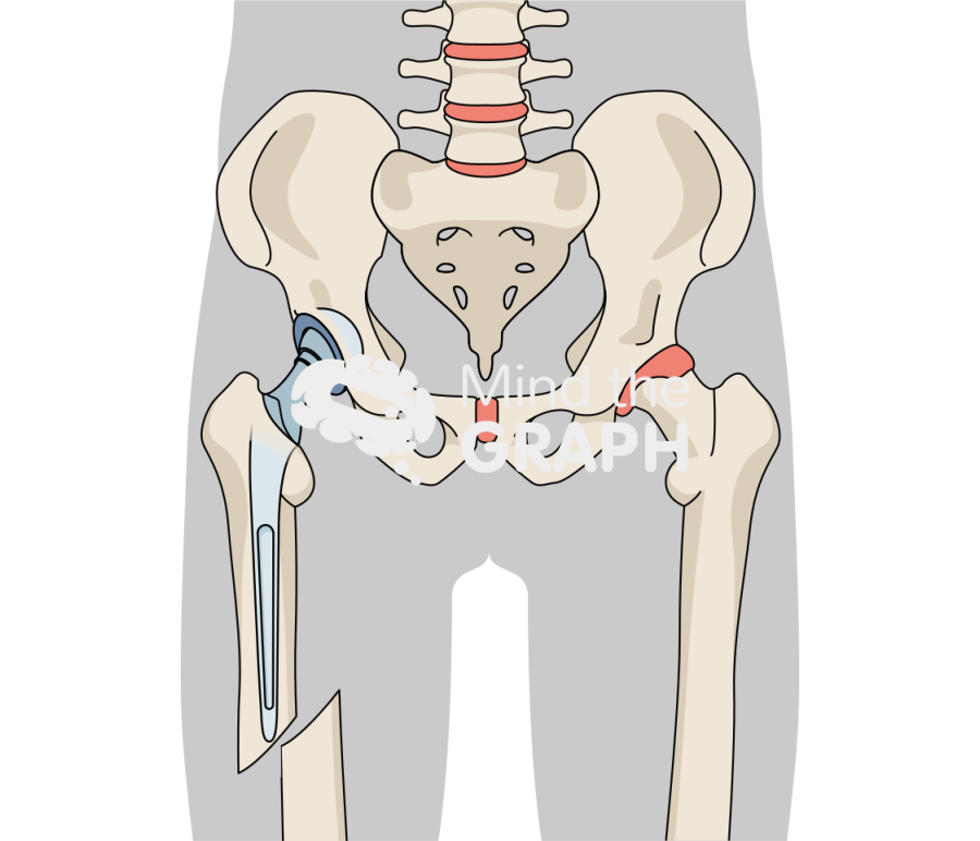 Total hip arthroplasty periprosthetic fracture body Icons, Symbols, Pictures, and Images