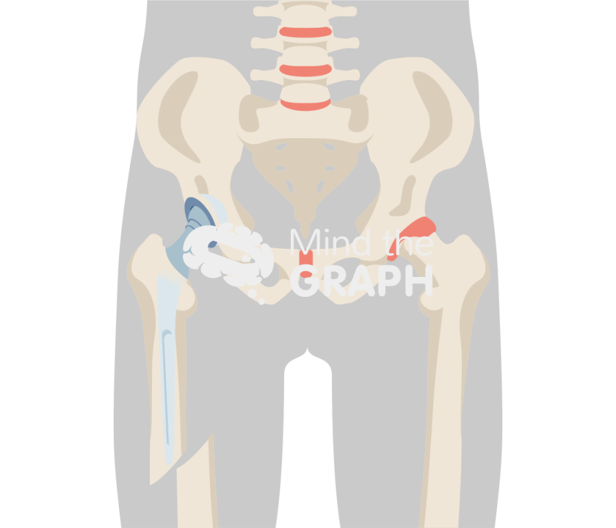 Total hip arthroplasty periprosthetic fracture body Icons, Symbols, Pictures, and Images
