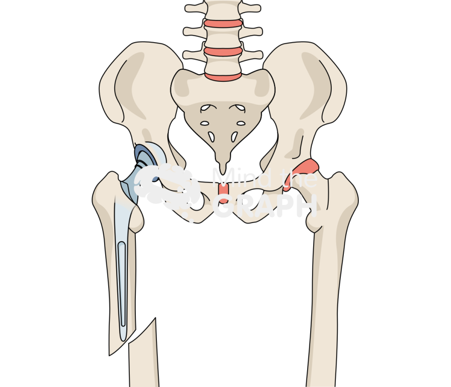 Total hip arthroplasty periprosthetic fracture bone full Icons, Symbols, Pictures, and Images